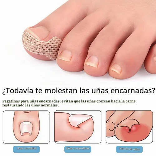 Vista 3 de Tratamiento de uñas encarnadas, 100 tiras transpirables de uñas encarnadas, herramienta de uñas encarnadas sin dolor, pedicura profesional