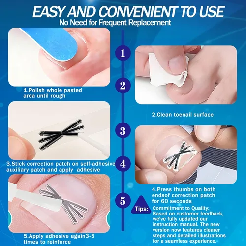 Vista 6 de Tratamiento de uñas encarnadas con forma mejorada de 6 ángulos, corrector de uñas encarnadas de aleación de titanio para un alivio rápido, kit