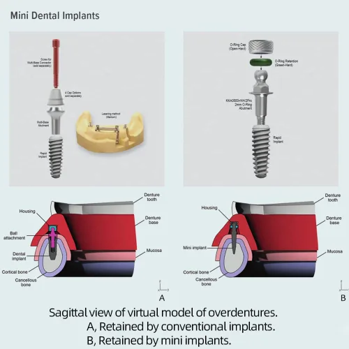 Vista 8 de Junta tórica, Buna-n, kit de herramientas con 3 tamaños convenientes, reemplazo para mini implantes dentales