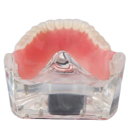 Vista 4 de Modelo de restauración dental con 4 implantes Sobredentadura Inferior Enseñanza Estudio Modelo de Dientes