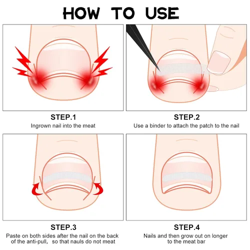 Vista 5 de 60 tiras correctoras de uñas encarnadas, corrección de uñas encarnadas, corrección de uñas, clip para enderezar uñas, parche curvo corrector de uñas