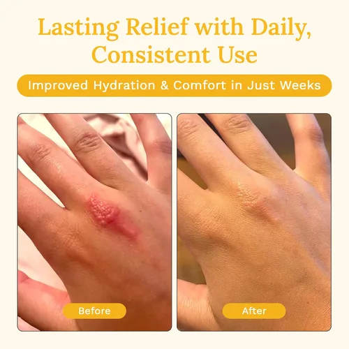 Vista 6 de Rejuvaskin Crema de recuperación de la piel con aloe vera, crema para aliviar el eccema para pieles secas, picazón y sensibles, hidratante