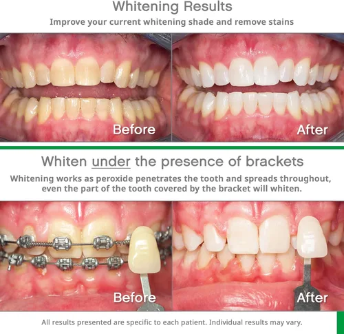 Vista 3 de Opalescence Opalescence Go - Bandejas blanqueadoras precargadas con peróxido de hidrógeno al 15% y pasta de dientes blanqueadora, sabor menta