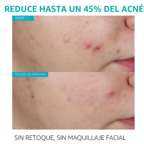 Vista 2 de La Roche-Posay Effaclar - Suero de ácido salicílico al 1,5%, tratamiento para el acné para la cara con ácido glicólico y niacinamida, suero