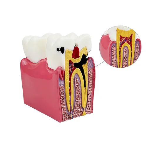 Vista 4 de Modelo de dientes de caries dental, modelo YOUYA DENTAL 6 veces de dientes de caries modelo de anatomía dental para educación de dientes