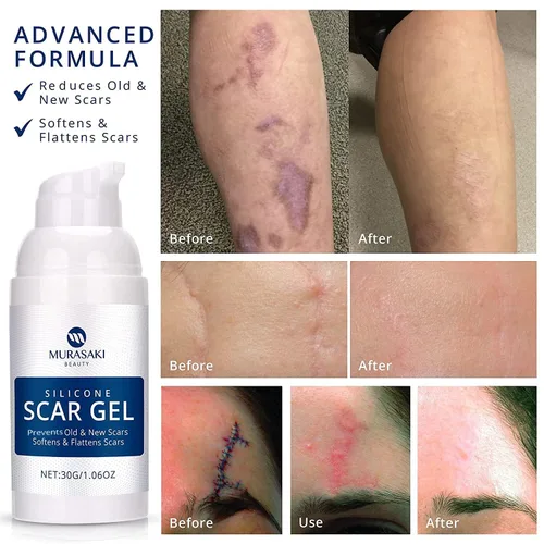 Vista 3 de Solución completa para el cuidado de cicatrices – Cinta de silicona para cicatrices + hojas de cicatrices + tratamiento de gel 100% de silicona