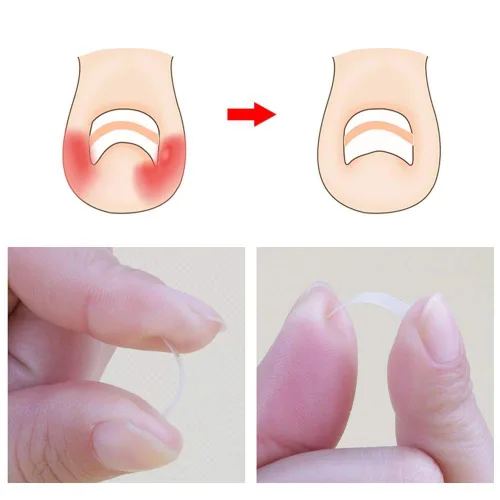 Vista 3 de Tiras correctoras de uñas encarnadas Brace 10 unids/botella enderezadora clip curvado BS Brace uñas de los pies gruesa corrección herramienta de pie