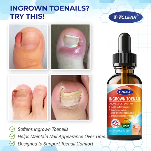 Vista 2 de Alivio de Uñas Encarnadas: Herramienta para Uñas Encarnadas para Hombres Mujeres - Kit de Eliminación de Uñas Encarnadas - Gotas Correctoras de Uñas