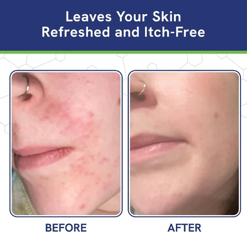 Vista 6 de pHat 5.5 Crema Hidratante para Dermatitis Seborreica y Loción Facial para Mujeres - Crema Calmante para el Enrojecimiento de Cara y Cuerpo - Crema