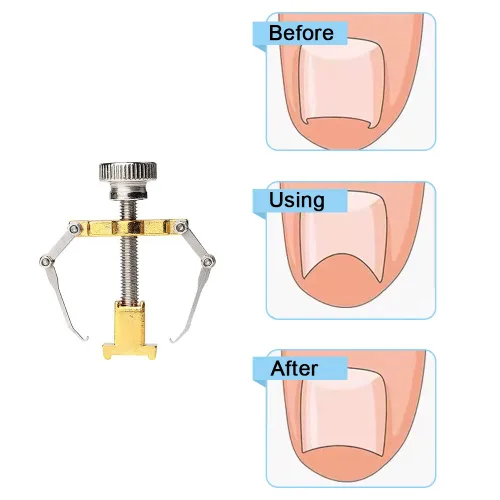 Vista 6 de Corrector de uñas encarnadas profesional encarnadas levantador de uñas encarnadas práctica abrazadera para el tratamiento de uñas encarnadas