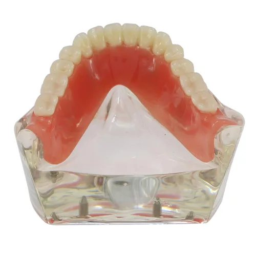 Vista 4 de Demostración inferior inferior inferior de la restauración del modelo M6003 Typodont Sobredentadura 4 implantes inferior inferior de los dientes