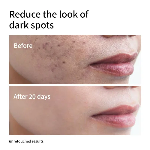 Vista 6 de Suero facial de niacinamida 10% + zinc 1% Control avanzado del tono de la piel y el aceite Fórmula hidratante y antimanchas Ligero y de rápida