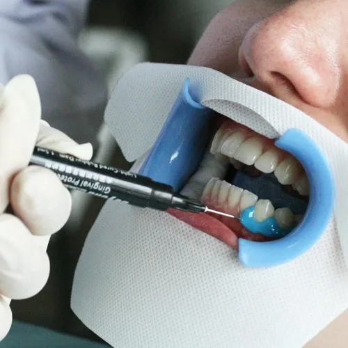Vista 4 de BEYOND BlueSeal - Protección gingival (paquete de 10)