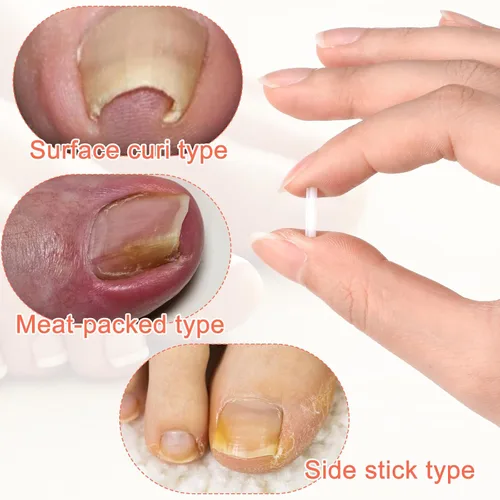 Vista 5 de (50+2) Juego de corrector de uñas encarnadas con cortaúñas, kit profesional de eliminación de uñas encarnadas sin dolor con levantador, tira de uñas