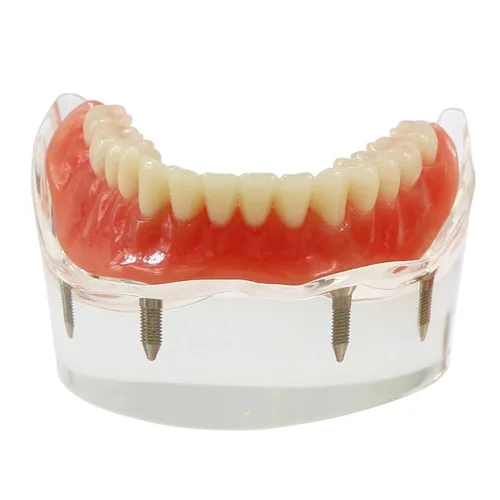 Vista 3 de Demostración inferior inferior inferior de la restauración del modelo M6003 Typodont Sobredentadura 4 implantes inferior inferior de los dientes