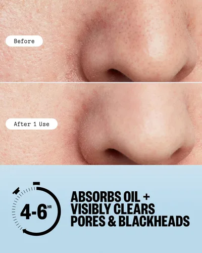 Vista 4 de PEACE OUT Tiras de poros para nariz y cara, removedor de puntos negros hidrocoloide absorbente de aceite, tiras minimizadoras de poros con retinol