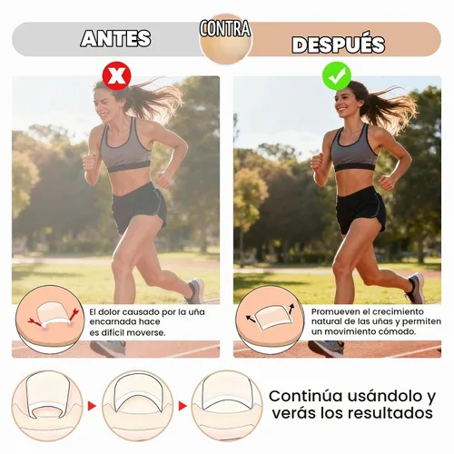 Vista 4 de 100 tiras correctoras de uñas encarnadas, tratamiento de uñas encarnadas, alivio del dolor para uñas curvas, herramienta de corrección de uñas
