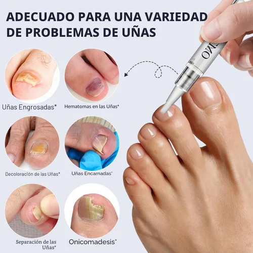Vista 4 de Pluma de hongos en las uñas de los pies, tratamiento de uñas extra fuerte, 25% ácido undecilénico, aceite de árbol de té, bolígrafo de reparación