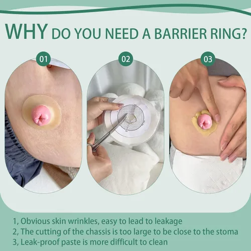 Vista 3 de 30 anillos de barrera para ostomía, sellos cohesivos de cinta hidrocoloide de 0.079 pulgadas de grosor, extensor elástico moldeable de piel
