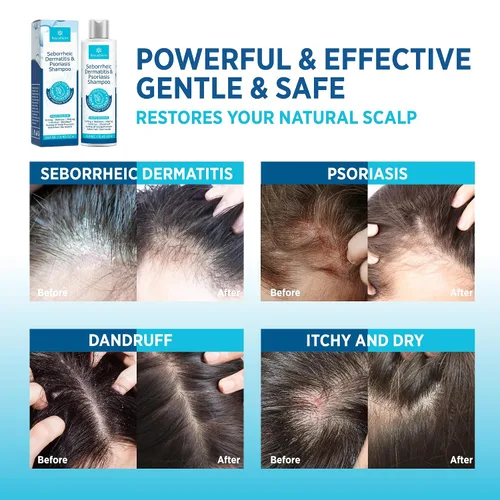 Vista 3 de Roycederm Set de champú y acondicionador para dermatitis seborreica y psoriasis, tratamiento eficaz del cuero cabelludo para foliculitis, psoriasis