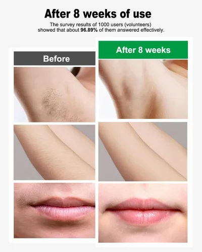 Vista 3 de Dispositivo de depilación láser IPL para mujeres y hombres en casa actualizado a 999,900 destellos permanentes para piernas faciales, brazos, línea