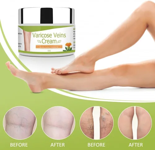 Vista 6 de Crema para venas varicosas, crema corporal, crema natural y pura para venas varicosas para piernas elimina las venas varicosas y las arañas