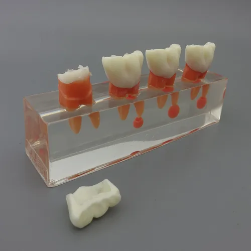 Vista 4 de Modelo de dientes dentales Modelo de tratamiento endodóntico de 4 etapas para estudiar y enseñar..