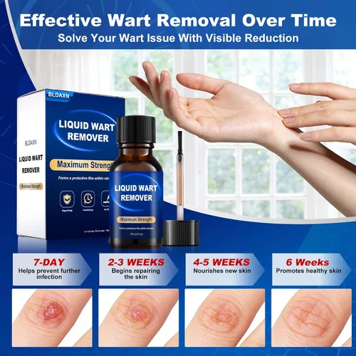 Vista 5 de Fast-Acting Wart Remover Freeze Off & Corn Remover, 2-Pack 30 ml Salicylic Acid Plantar Wart Remover for Feet, Hands & Skin - Professional Wart