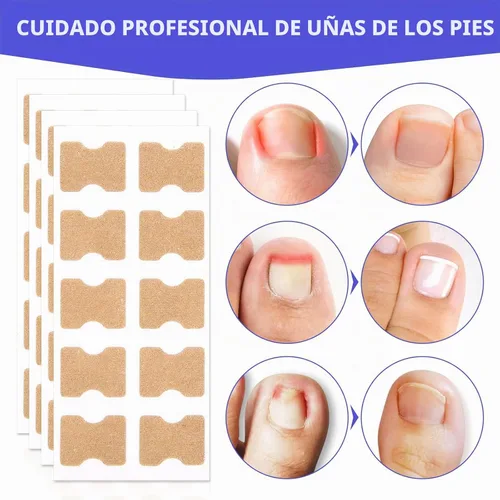 Vista 4 de Parche corrector de uñas encarnadas, 100 tiras correctoras de uñas encarnadas, parches de corrección de uñas de los pies, herramienta de tratamiento