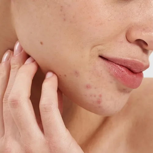 Vista 4 de PAI SKINCARE - Potenciador aclarante de ácido salicílico natural Cuidado de la piel natural, vegano y sensible (0.3 fl oz 0.3 fl oz)