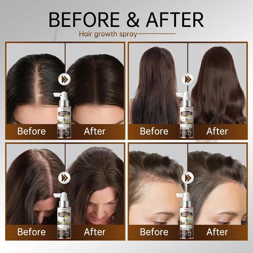 Vista 5 de PKU Aerosol para el crecimiento del cabello, suero capilar con biotina y aceite de romero, cuidado nutritivo del cuero cabelludo para adelgazar