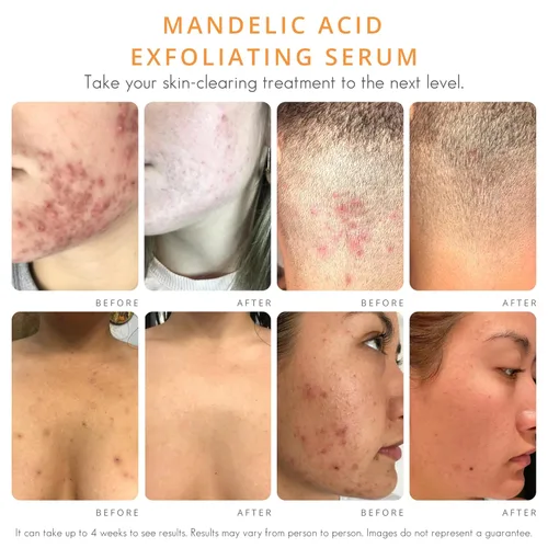 Vista 3 de Almond Clear Suero de nivel 1 Suero facial de ácido mandélico para acné, foliculitis, piel envejecida, pelos encarnados, manchas oscuras