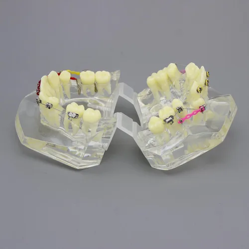 Vista 5 de Modelo dental de los dientes del tratamiento de ortodoncia de la maloclusión con los soportes del metal Alambres Cadenas y aros coloridos