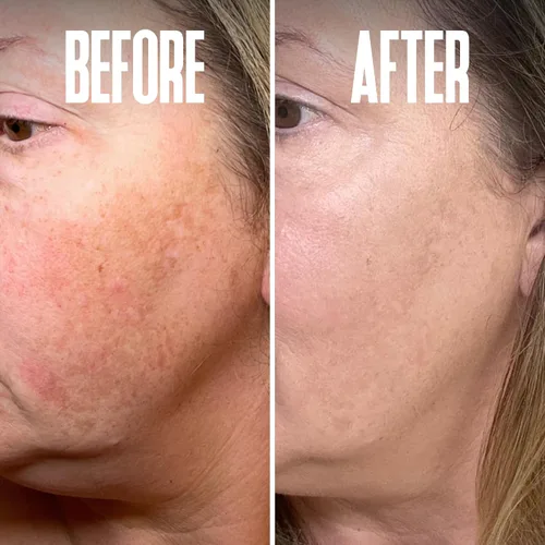 Vista 7 de Eliminador corrector de puntos oscuros de hidroquinona 2% para el tratamiento facial y melasma, contiene vitamina C, ácido salicílico, ácido kójico