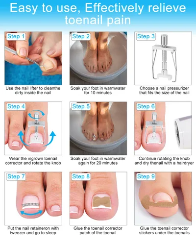 Vista 5 de Kit de eliminación de uñas encarnadas, tratamiento de uñas encarnadas, herramientas correctoras de uñas encarnadas vienen con soportes para uñas