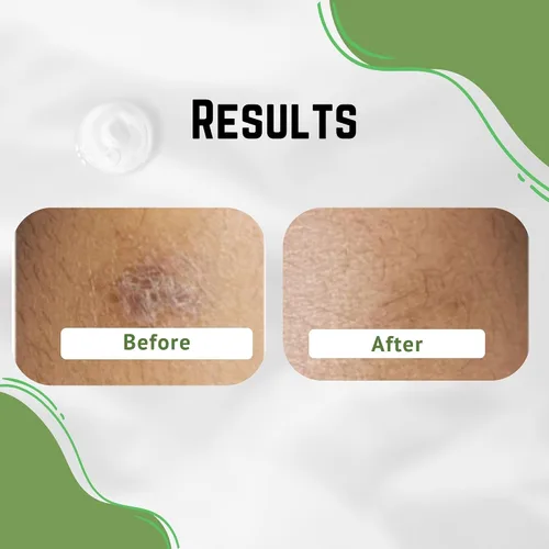 Vista 8 de Crema de aloe vera, corrige marcas oscuras, piel seca y nuevas cicatrices en el cuerpo, crema facial para imperfecciones, reduce la apariencia