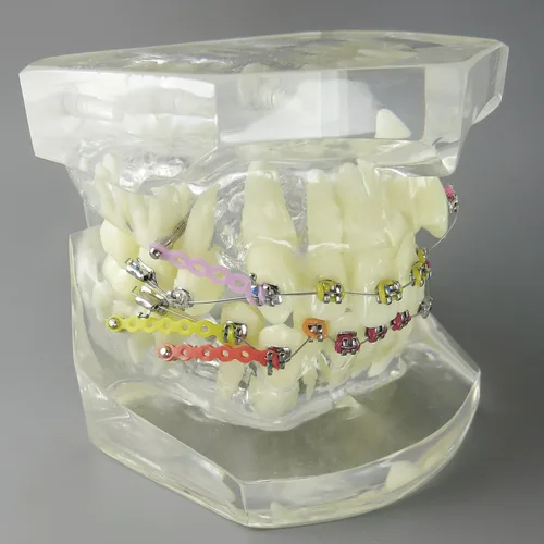 Vista 2 de Modelo dental de los dientes del tratamiento de ortodoncia de la maloclusión con los soportes del metal Alambres Cadenas y aros coloridos