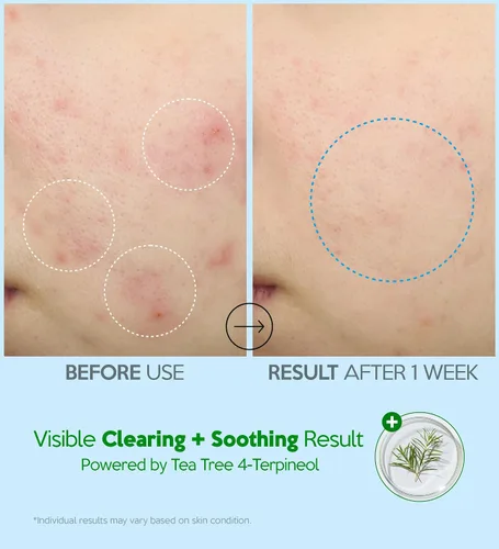 Vista 5 de Troubless Hydro Crema hidratante calmante – Crema hidratante profunda y barrera cutánea para la cara con 10,000 ppm de pantenol y árbol de té