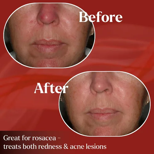 Vista 4 de PyratineXR Crème - Tratamiento antienvejecimiento y rosácea - Ultimate Cytokinin Skin Cream Reduce el enrojecimiento facial, lesiones de acné