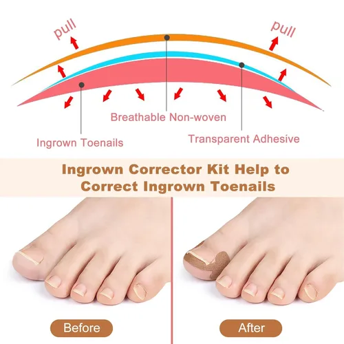 Vista 3 de Juego de corrector de uñas encarnadas con tiras correctoras – Kit de herramientas profesionales para uñas de los pies que incluye tiras