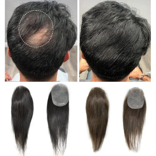 Vista 3 de Unidad de reemplazo de parche para cabello calvo en V de piel fina para línea capilar – 100% Remy humano transparente piel tupé sistemas frontales