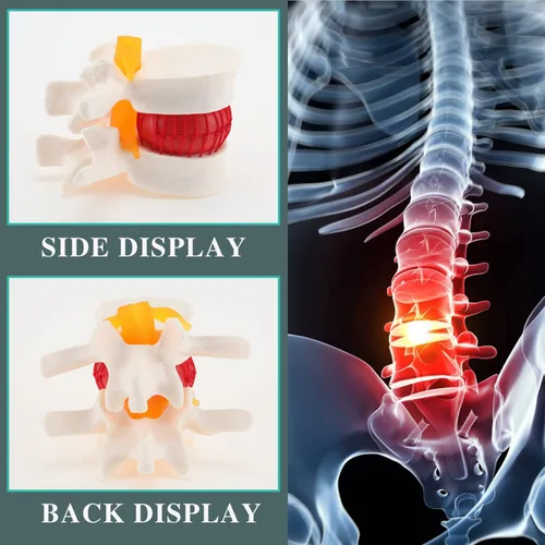 Vista 5 de RONTEN Modelo de hernia de disco lumbar de tamaño real, modelo de hernia de disco lumbar anatómica humana, modelo anatómico de columna lumbar