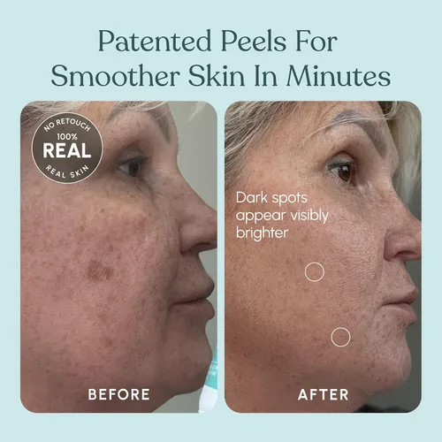 Vista 6 de 30 DAY MIRACLE AHA 30% + BHA 2% Solución de peeling – Exfoliante líquido de fuerza clínica para manchas oscuras, puntos negros y poros obstruidos