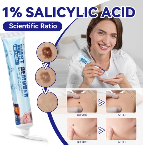 Vista 2 de Crema eliminadora de verrugas genitales, ungüento de verrugas de acción rápida con máxima fuerza para uso doméstico, seguro y eficaz (3 tubos)
