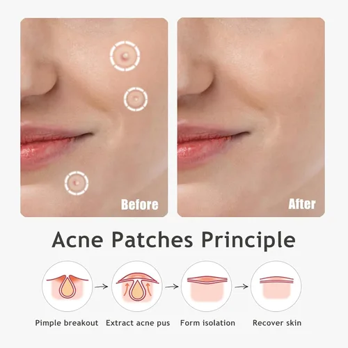 Vista 5 de Ultra - Parches de espinillas hidrocoloides, 120 unidades Acne Patch for Covering Zits and Blemishes Breakouts Spot Acne Dots Stickers for Face