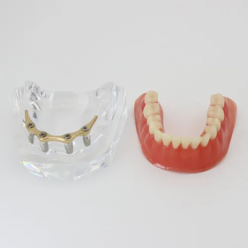 Vista 5 de Color dorado dental del diente inferior de la sobredentadura del implante de la precisión 4 modelo de los dientes
