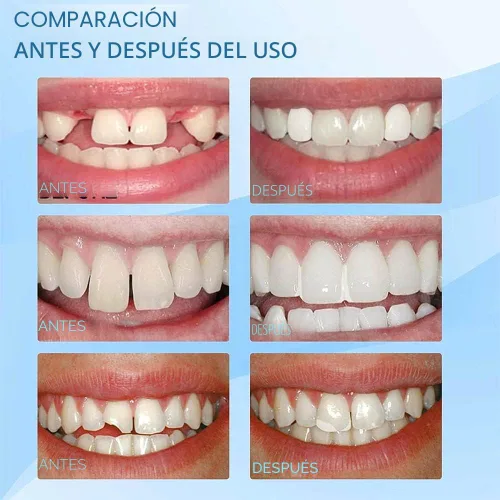 Vista 5 de Kit de reparación dental, perlas para reparación de dentaduras, pinzas, mondadientes, herramientas dentales para fijar, rellenar, dientes faltantes
