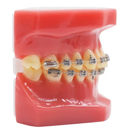 Vista 3 de Brcket dental del metal de ortodoncia con el modelo de los dientes de Typodont