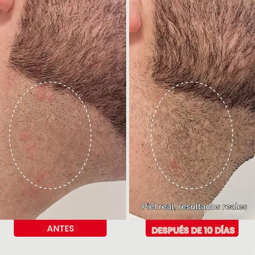 Vista 5 de First Aid Beauty Ingrown Hair Pads with BHA and AHA