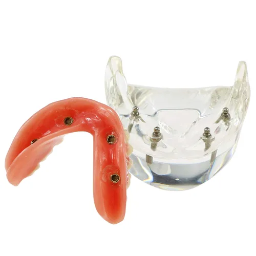 Vista 9 de Demostración inferior inferior inferior de la restauración del modelo M6003 Typodont Sobredentadura 4 implantes inferior inferior de los dientes